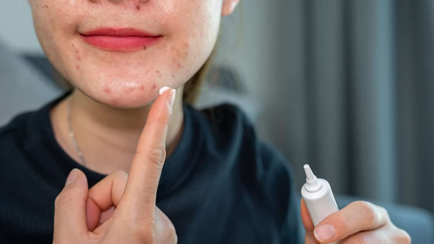 Adapalene and Benzoyl Peroxide: The Ultimate Acne-Fighting Duo 1 Clear, blemish-free skin showing the powerful effects of benzoyl peroxide in acne treatment