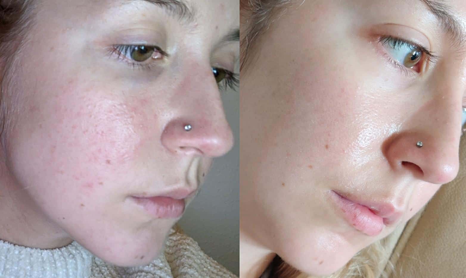 Applying azelaic acid 15% serum to acne-prone skin