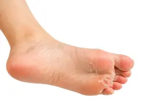 Effective Treatments for Athlete's Foot Relief