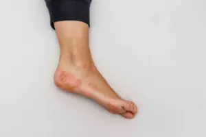 Choosing the Best Foot Rash Cream