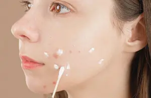 adapalene and benzoyl peroxide is a powerful solution to combat acne effectively