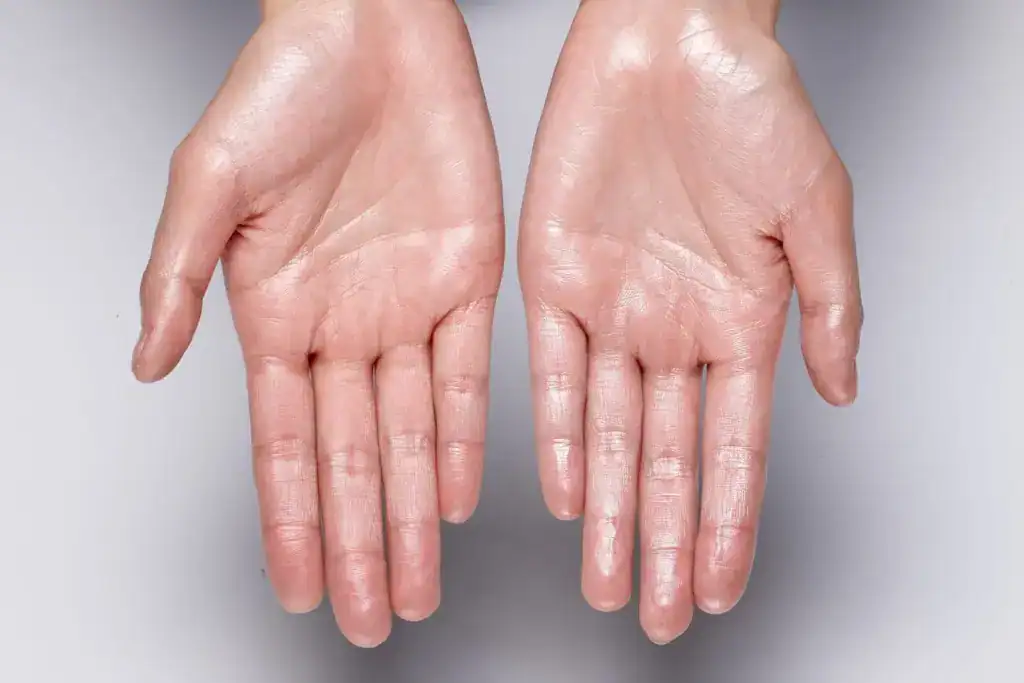 Top Prescription Deodorants for Hyperhidrosis Relief